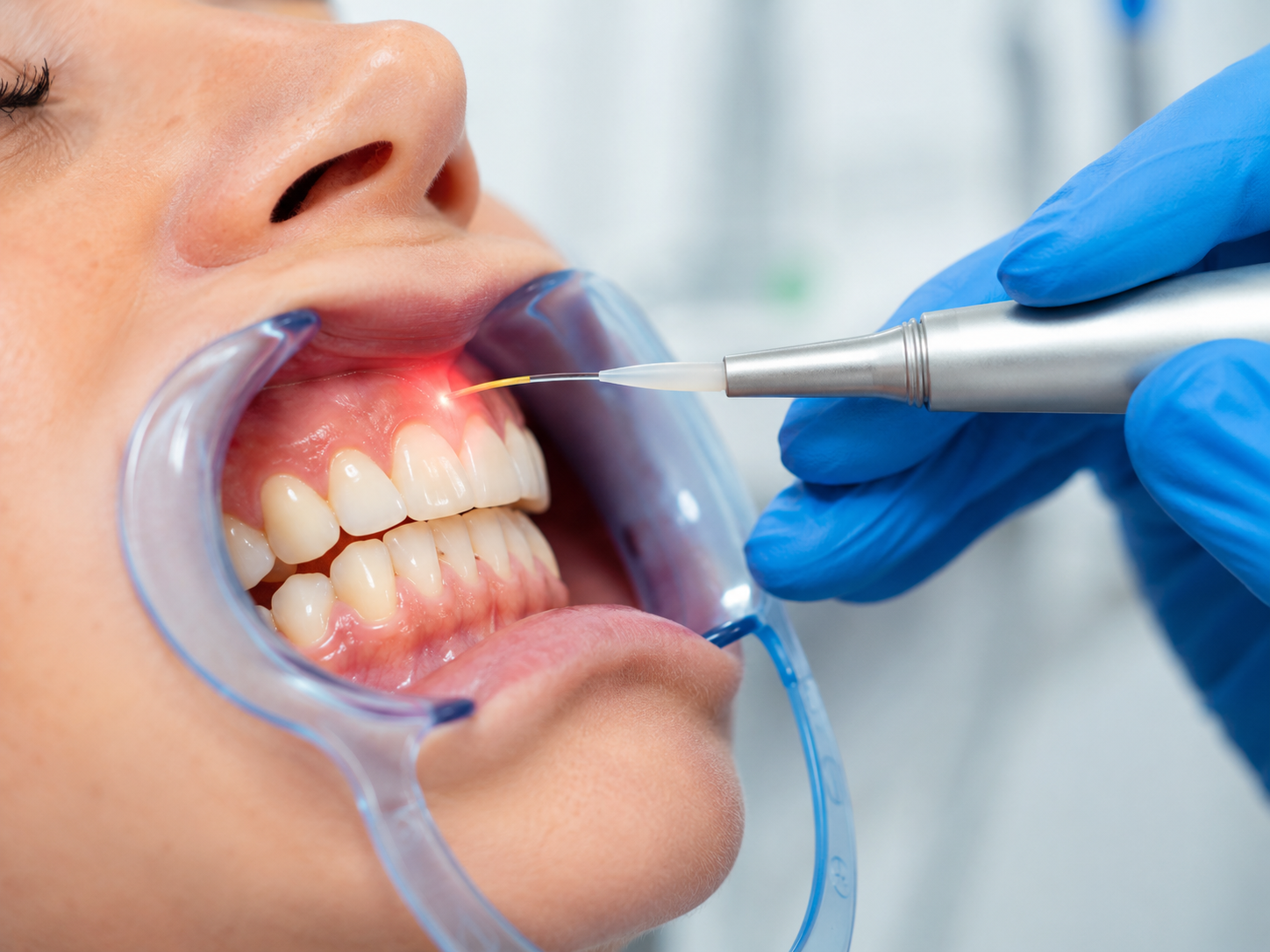 Close-up view of LANAP laser periodontal treatment